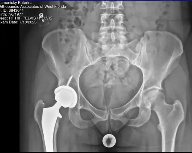 Enhancing Joint Replacement Rehabilitation